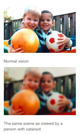 Cataract-before-and-after