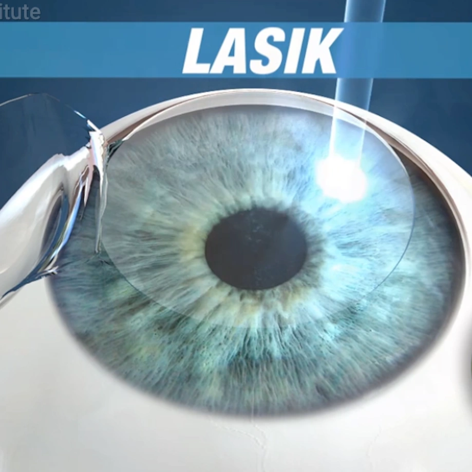 LASIK video preview