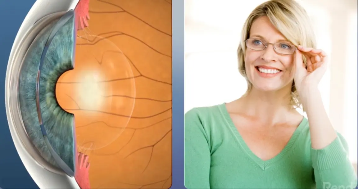 cataracts video preview